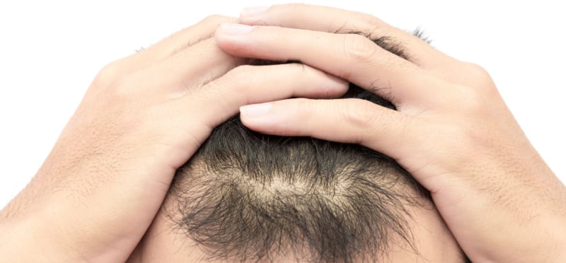 Hair Transplants Surgery