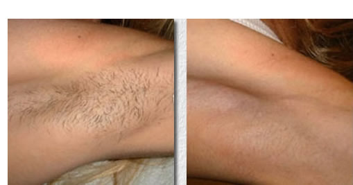 Laser hair Removal before and after armpits