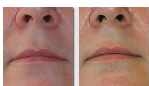 Laser Hair Removal Before & after lip