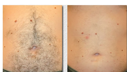 Laser Hair Removal Before & after stomach