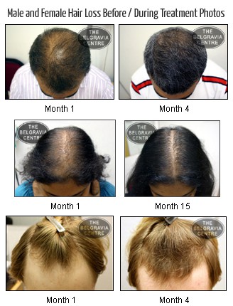 Effective Hair Loss Treatment Courses